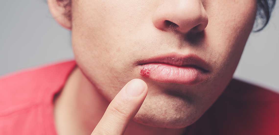 A person pointing to a cold sore on their bottom lip