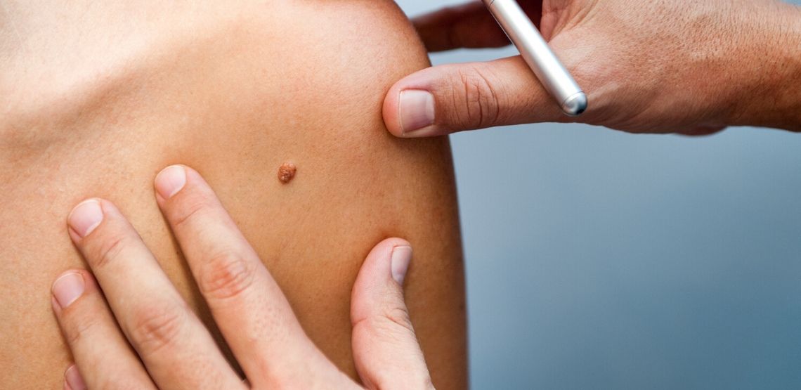 doctor checking a mole for signs of skin cancer