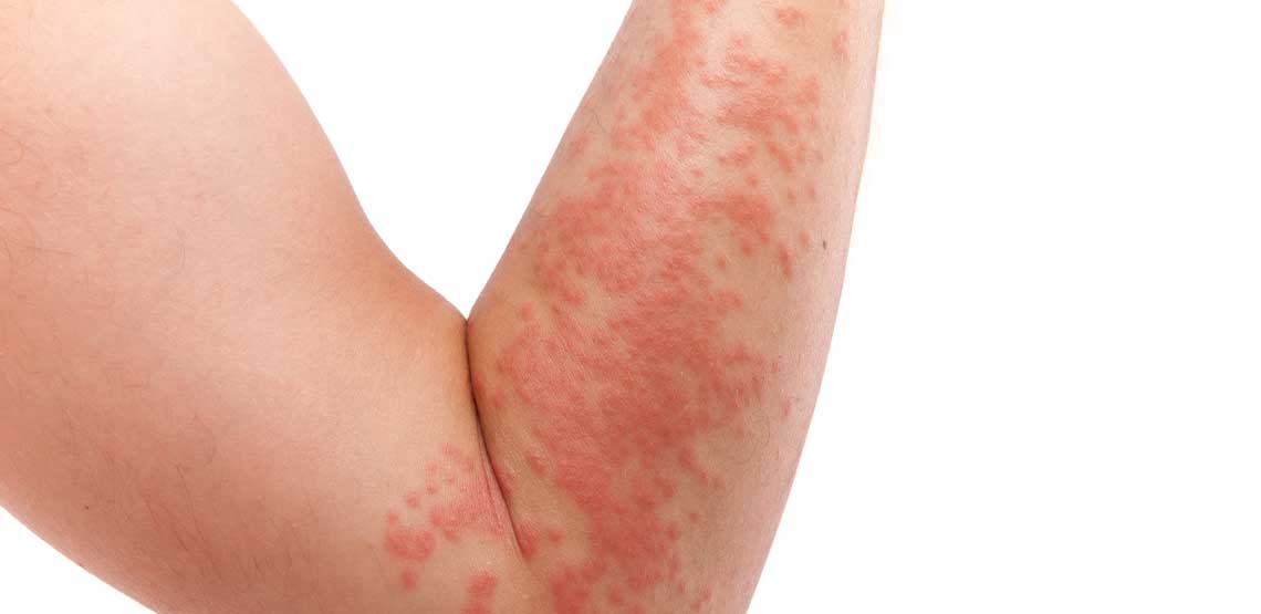 Psoriasis on a person's arm.