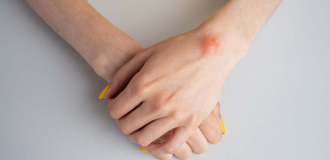 A person crossing their hands, with a reddened lipoma on one of their hands.