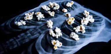Pieces of popcorn on an x-ray of lungs.